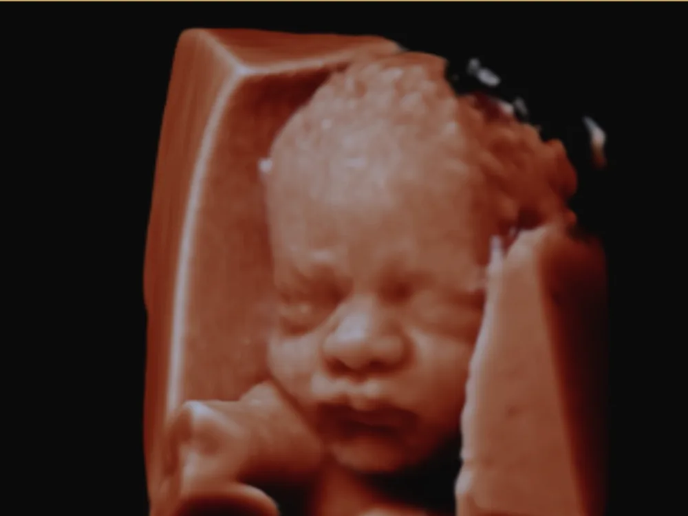 Fetal face at 30 weeks