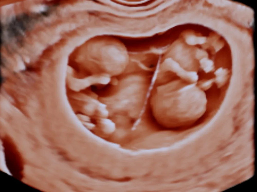 Twin pregnancy