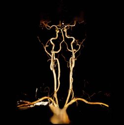 Angiography