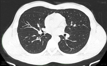 Thorax