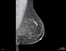 Mammography
