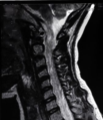Spine