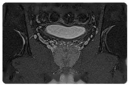 Pelvis