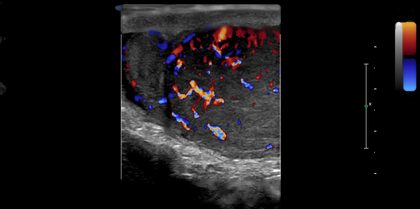 Colour Doppler