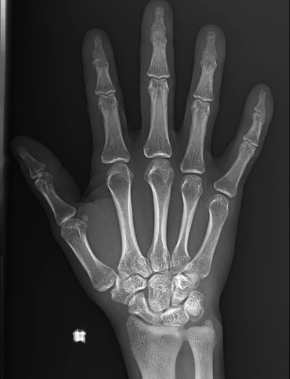 Upper extremities