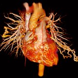 CT Scan