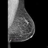 Digital Mammography