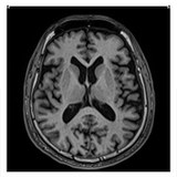 MRI Scan